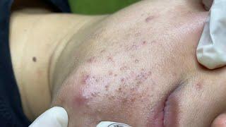 Acne treatment for Spa Linh Mun #019