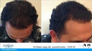 Alopecia Grado 5, Implante de 2743 Unidades | Capilea México