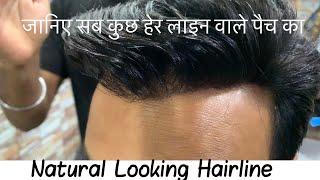 Everything About Q6 Patch or  Hairline Patch / जानिए सब कुछ हेयर लाइन पैच के बारे में | 9953384242