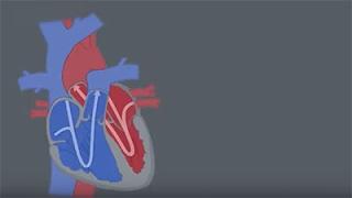 Congenital Heart Defects (CHDs)