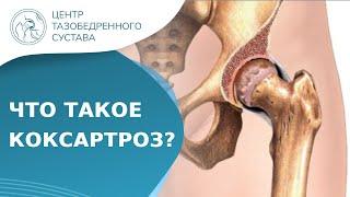  Что такое коксартроз (артроз тазобедренного сустава)? Что такое коксартроз. 18+