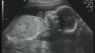 24 weeks / 6 months pregnant ultrasound sonogram