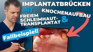 Implantatbrücken mit freiem Schleimhauttransplantat und Knochenaufbau | Fallbeispiel