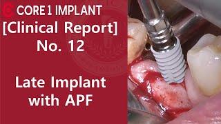 [CYBERMED Clinical Report] #46 Late implant placement with Apically positioning flap