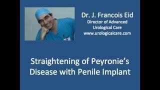 Straightening of Peyronie's Disease with Penile Implant