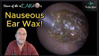 Nauseous Ear Wax! Ep 132 #ear #earwax #earwaxremoval #earcleaning #earwaxclinic #earwaxextraction