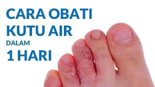 CARA MENGOBATI KUTU AIR DI KAKI DAN TANGAN