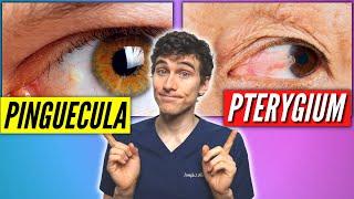 Pinguecula Vs Pterygium (Signs, Symptoms, Treatment)