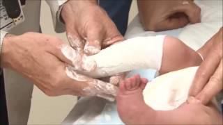 Casting of a Child With Clubfoot Using the Ponseti Method