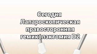 Лапароскопическая правосторонняя гемиколэктомия. Онкология кишечника. Лечение рака. Хирург Никонов.