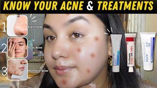 Pharmacy Creams to Treat Your Acne Right !