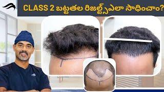 Hair Transplant In Hyderabad | Best Results Surgeon & Cost  Of Hair Transplant Surgery In Hyderabad