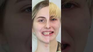 ДО/ПОСЛЕ дистальный прикус