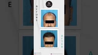 Best hair transplant clinic in Pune | Dr. Rashmi Aderao Skin, Hair & Laser Clinic