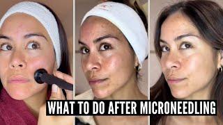 8 Important Microneedling Aftercare Tips YOU MUST KNOW