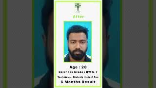 Hair Transplant in Mumbai | Best Hair Transplant Resuls