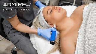 Rewrite Your Skin’s Story - SkinPen® For Acne Scars! AdmireMD Skin Clinic