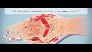 HUMIRA® (adalimumab) Mechanism of Action in Psoriatic Arthritis