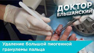Большая пиогенная гранулема пальца - удаление хирургическим путем