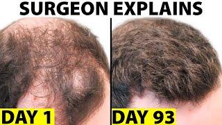 Oral Minoxidil - A Better Hair Loss Treatment?