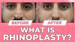 ️ What is Rhinoplasty? Rhinoplasty Procedure | Before and After Results of Rhinoplasty