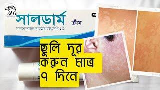 Sulderm cream uses | সালডার্ম ক্রিম | ছুলি রোগের চিকিৎসায়