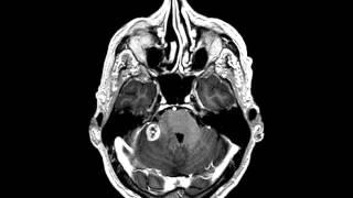 CEREBELLAR METASTASIS - SERVICIO NEUROCIRUGÍA UNIDAD DE RAQUIS - HUMV