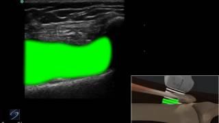 How to: Ultrasound Guided Injection of the Lateral Knee 3D Video