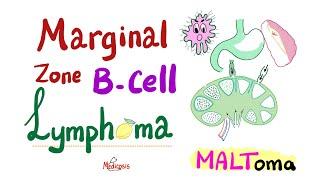 Marginal Zone B-Cell lymphoma (MALToma) - Indolent B-Cell Non-Hodgkin’s Lymphoma - Hematology/ Onco