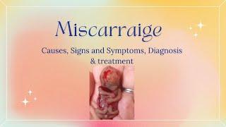 MISCARRIAGE, Causes, Signs and Symptoms, Diagnosis and Treatment.