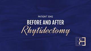 Rhytidectomy (Facelift) After Massive Weight Loss {Patient 3042} Before & After