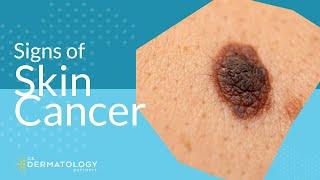 Skin Cancer Screening | Symptoms, Types & Warning Signs