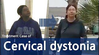 Dystonia / Cervical Dystonia / Spasmodic Torticollis / 사경증 치료사례 / 근긴장이상증