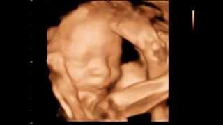 3D Ultrasound Burnaby - 3D Sono Image