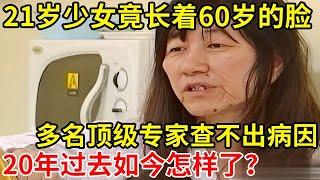 2004年,21岁妙龄少女竟长着60岁的脸!多名专家都查不出病因,如今怎样了【人间故事】