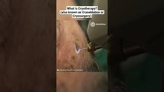 What is Cryotherapy (also known as Cryoablation or Cryosurgery)?