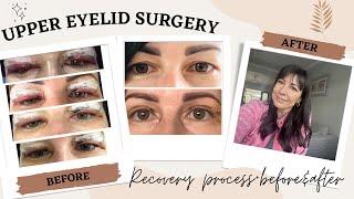 MY EYELID SURGERY (BLEPHAROPLASTY) | RECOVERY PROCESS & WHAT TO EXPECT! | Before & after pictures