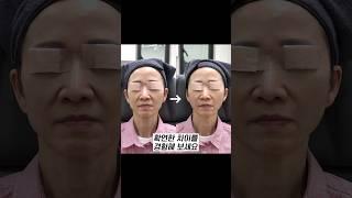 전문의의 개인별 맞춤 실리프팅, 결과는?!｜시술 전후 비교