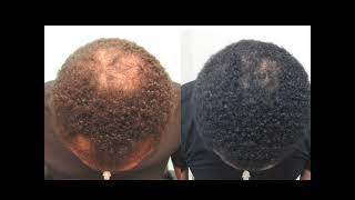 Hair Loss Treatment for Men - Black Men Hair Loss no Surgery