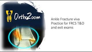 Ankle Fracture dislocation - viva practice for FRCS T&O