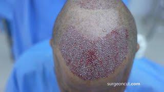 Hair Transplant Surgery 3000 Grafts India - Full Procedure (GRAPHIC)