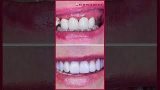 Understanding Dental Implants: The Full Journey from Start to Follow-Up | Dr. Aroon K. Bengani