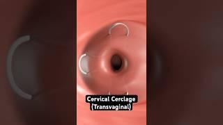 Stitching the cervix to prevent miscarriage (3D animation