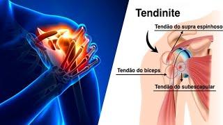 5 remédios caseiros para tratar a Tendinite!