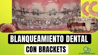 Blanqueamiento Dental con Brackets