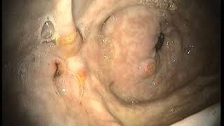 MED Equus Video Gastroscope, ulceration of pylorus