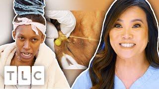 Dr. Sandra Lee Pops SIXTY Steatocystomas In THREE HOURS! | Dr. Pimple Popper