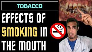 SMOKING effects on MOUTH and TEETH - consequences of TOBACCO cigarettes