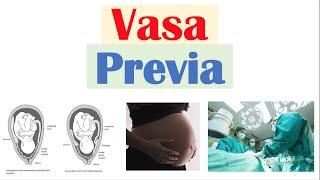 Vasa Previa (Obstetrical Condition) | Causes, Risk Factors, Signs & Symptoms, Diagnosis, Treatment