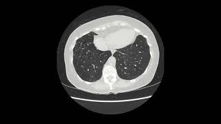 Pulmonary MAC infection